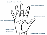 Vibration-related-damage-to-the-hands-1