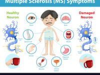 Multiple sclerosis (MS) symptoms information infographic