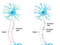 multiple-sclerosis-scaled
